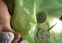 2-vjeçari nga Gjilani përpiu dy monedha, mjekët ia heqin me sukses