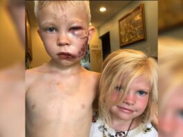 Gjashtëvjeçari mbron motrën nga qeni, por ai e kafshon në fytyrë